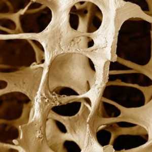 Osteoporoze. Šta je ovo patologija?