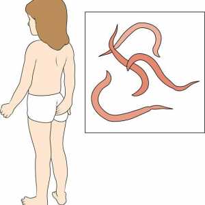 Pinworms u dijete: metode liječenja i prevencije bolesti