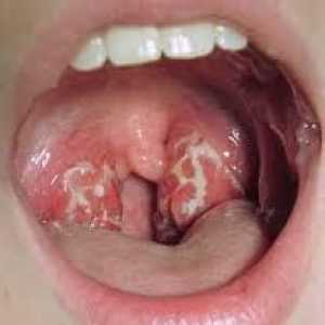 Gdje radi aureus u grlu. simptomi infekcije