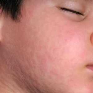 Mumps kod djece. Simptomi i liječenje bolesti