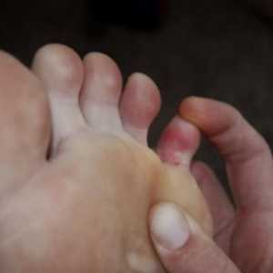 Prelom mali prst na nozi: Prva pomoć