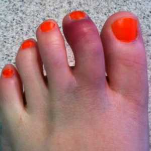Broken toe: Simptomi i metode tretiranja