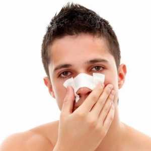 Nosne frakture: njihova simptomi i liječenje