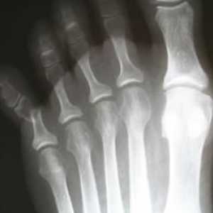 Preloma prstiju: uzroci, simptomi i tretmani