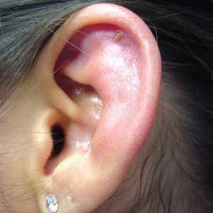Perichondrium uha: simptomi, liječenje, fotografije