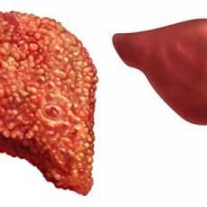 Primarni simptomi tseyroza jetre