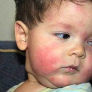 Alergije na hranu u djece: šta da radim?