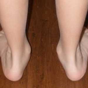 Iz nekog razloga, razvijaju flat-light noge kod djece i kako ih liječiti?