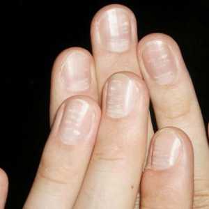 Zašto postoje bijele mrlje na noktima: najvjerovatniji uzroci