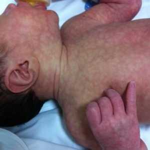 Zašto se kliker kože kod beba?