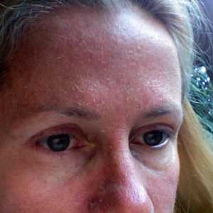 Zašto krljuštima kože na licu? Uzroci i tretman