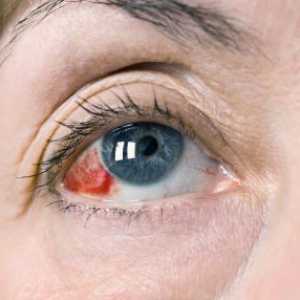 Zašto upala krvnih sudova u očima: uzroci i tretman
