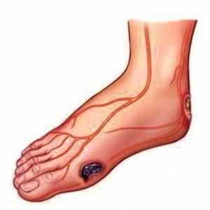 Detalji o tome šta i kako tretirati rane na nogama