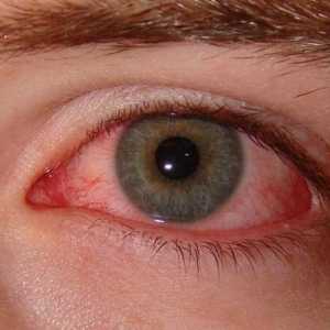 Crvenilo očiju: uzroci fenomena