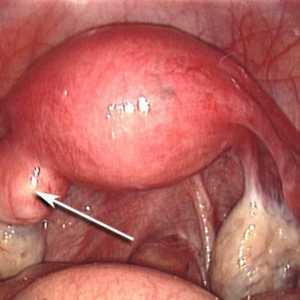 Endometrija polip: liječenje bez operacije i preglede