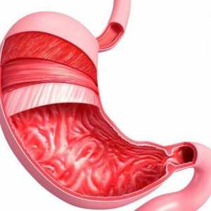 Površna gastritis: šta je to? Uzroci, Simptomi i metode tretiranja