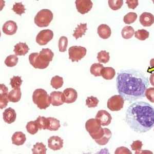 Povišena monocita u krvi - šta to znači?