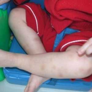Povećana trombocita u djeteta: ono što bi mogao biti razlog?