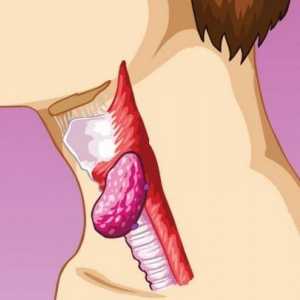Uzroci i simptomi upale limfnih čvorova na vratu