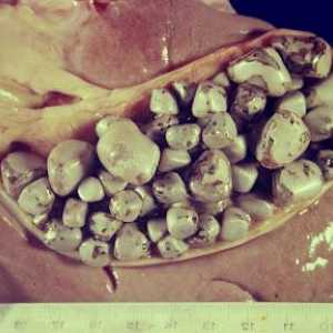 Uzroci, kliničke manifestacije i liječenje kamen u žuči bolesti