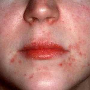 Uzroka simptoma i liječenje potkožnog grinja na licu