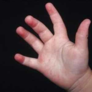 Znak bilo koje bolesti je osip na nogama i rukama djeteta