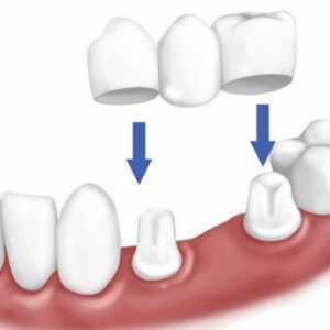 Proteza, u nedostatku velikog broja zuba: Vrste