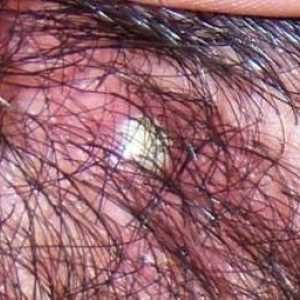 Akne na glavi ispod kose: uzroci i mogućnosti liječenja