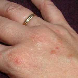 Bubuljice na rukama - uzroci i liječenje