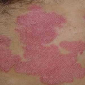 Psorijaza je zarazna ili ne - kako tretirati osobu sa sličnim manifestacijama na koži