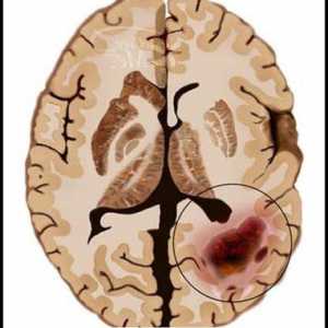 Mozak Rak: Uzroci, Simptomi i dijagnoza