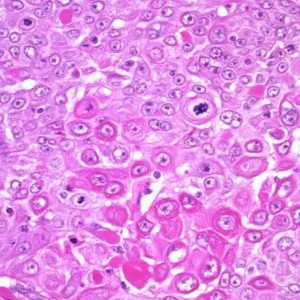 Planocelularni karcinom vrata maternice: prognozu, liječenje
