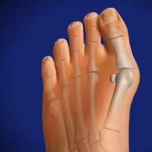 Raste kost u stopalu: uzroci, simptomi, tretman