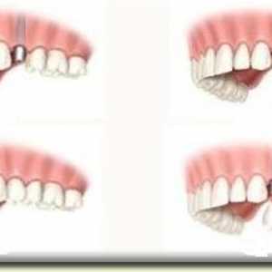 Restauracija zuba: kada i kako primijeniti postupak?