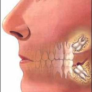 Impaktiranog zuba - to jest, kako da se tretira?