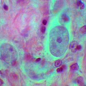 Najčešći protozoama infekcija