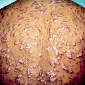 Sifilis: simptom bolesti i liječenja