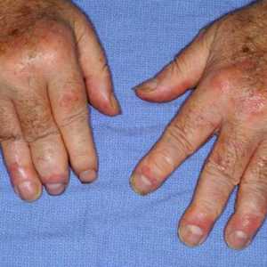 Simptomi i tretman Psorijazni artritis