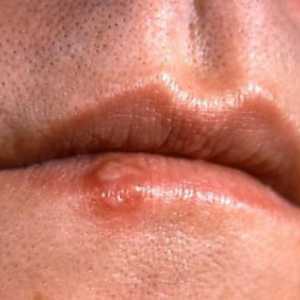 Simptomi raka usta - kako ih prepoznati?