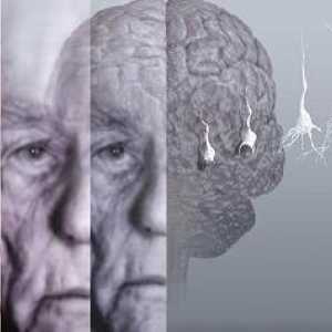 Demencije sindrom ili demencije