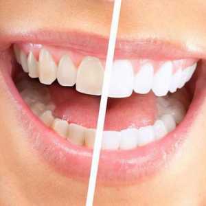 Zubi izbjeljivanje Global White: recenzije. Global White: prednosti i mane