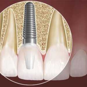 Koliko je da ubacite zube? Zubni implantati - alternativni način da se vrati u svoje bivše ljepote…