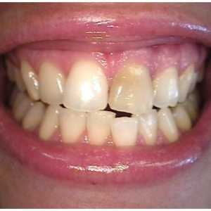 Moderne stomatologije: jedan izbjeljivanje zuba