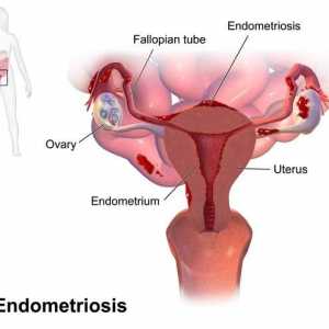 Spiral "Mirena" Endometrioza: recenzije