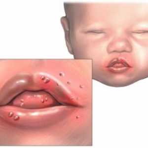 Stomatitis kod novorođenčadi: liječenje i prevencija