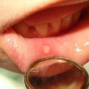 Stomatitis kod djece. Simptomi bolesti