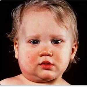 Mumps je dijete: simptomi koje vam mogu pomoći otkriti bolest