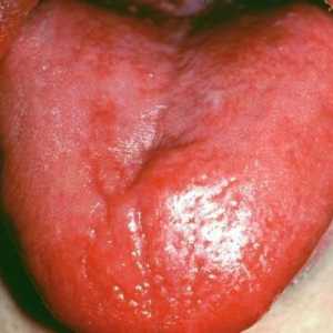 Tipični simptomi glositis