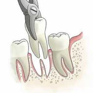 Uklanjanje korijena zuba - kompleks, ali najbezbolniji postupak