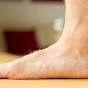 Vježbe za ravna stopala. Ortopedski ulošci za ravne noge